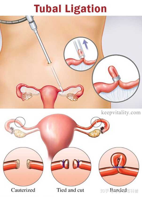 女性结扎的最新方法介绍